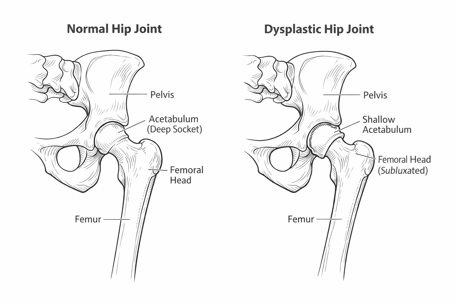 Dog hip dysplasia diagram comparing normal and dysplastic canine hip joint anatomy.